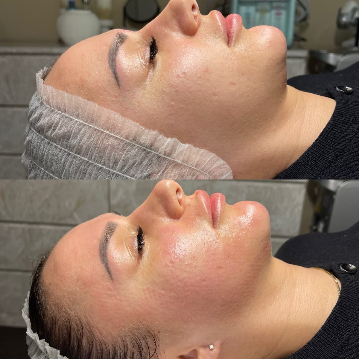 RF Microneedling 1